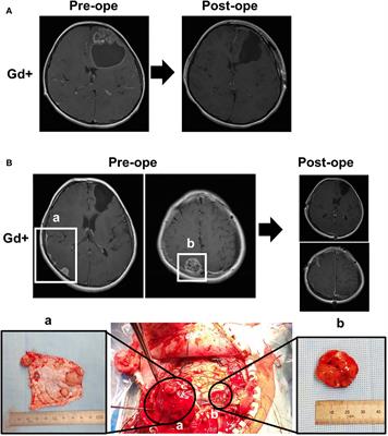 Case report: meningeal lymphangiogenesis around ependymoma forming along the dura matter